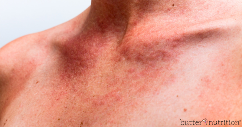 redness and skin rash on the chest